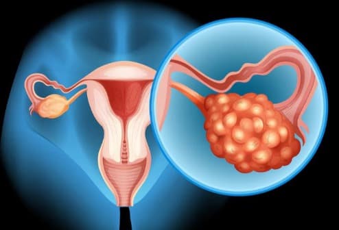 PCOS Management